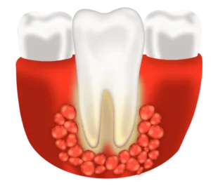 How to tell if you have a tooth abscess? 12 symptoms explained
