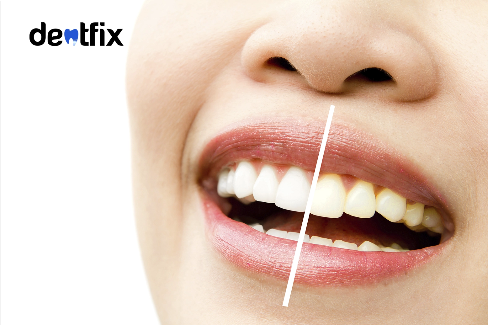Yellow Teeth: Teeth Discoloration Explained