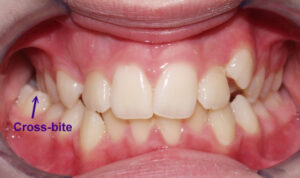 Can I get veneers if I have crossbite? Are they good for me?