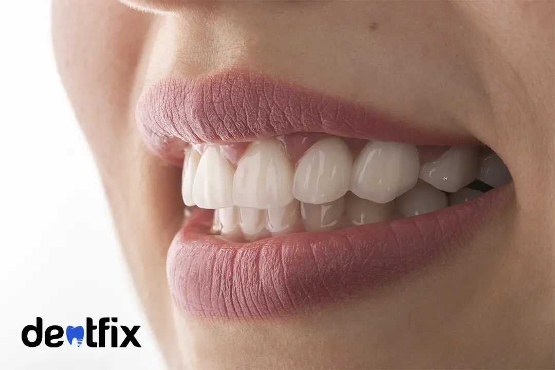 The Easy Guide On Veneers Side Effects: Pain, Sensitivity, Risks and More