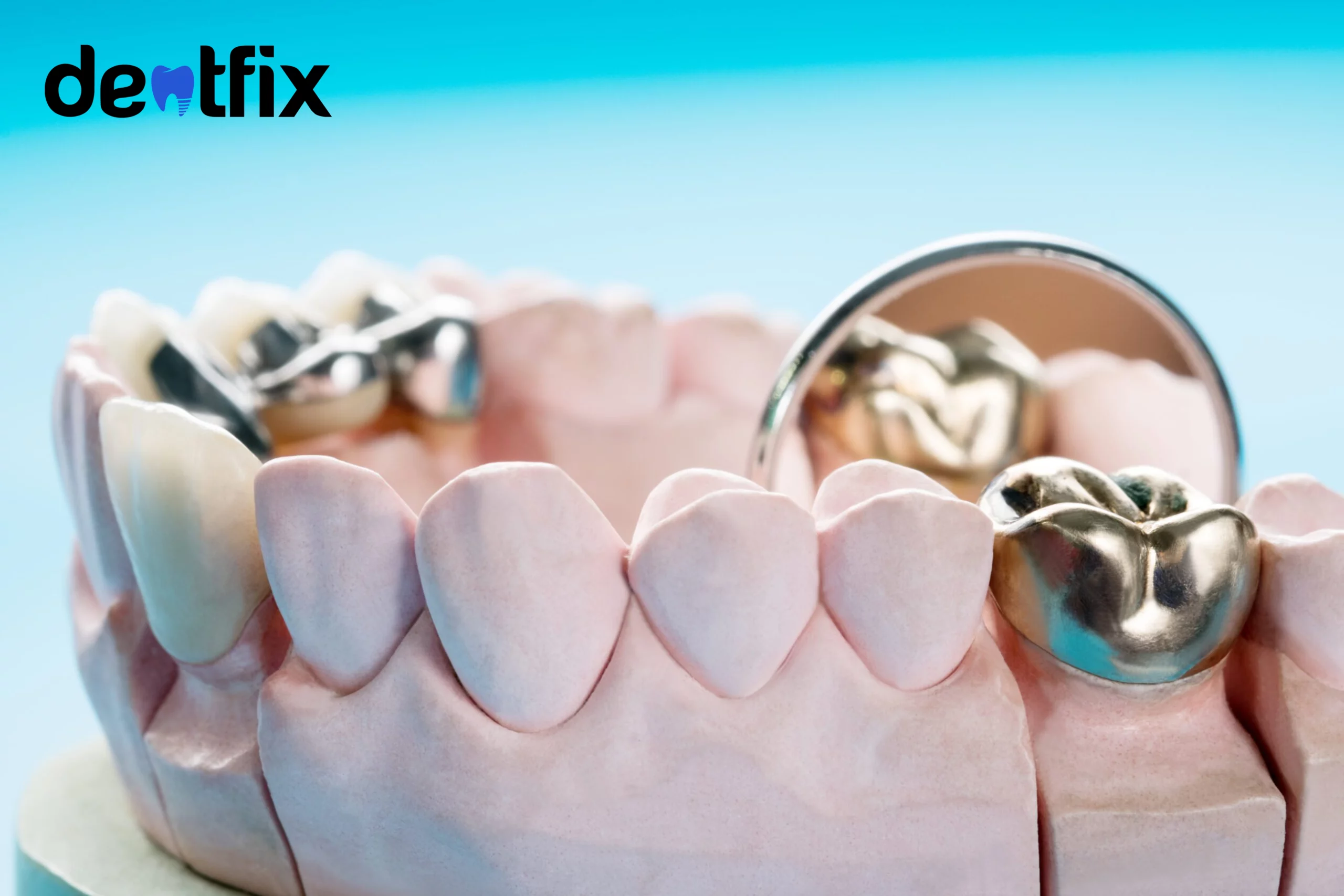 Dental Crowns: A Comprehensive Overview