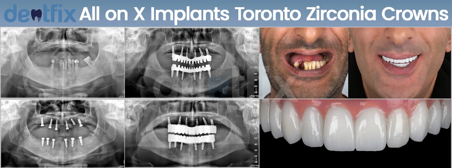 All-on-4 / All-on-6 full-mouth implant before and after — X-ray and smile, Dentfix Istanbul