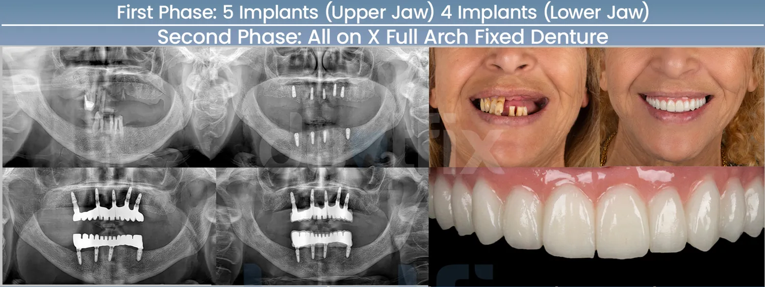 All-on-4 / All-on-6 full-mouth implant before and after — X-ray and smile, Dentfix Istanbul