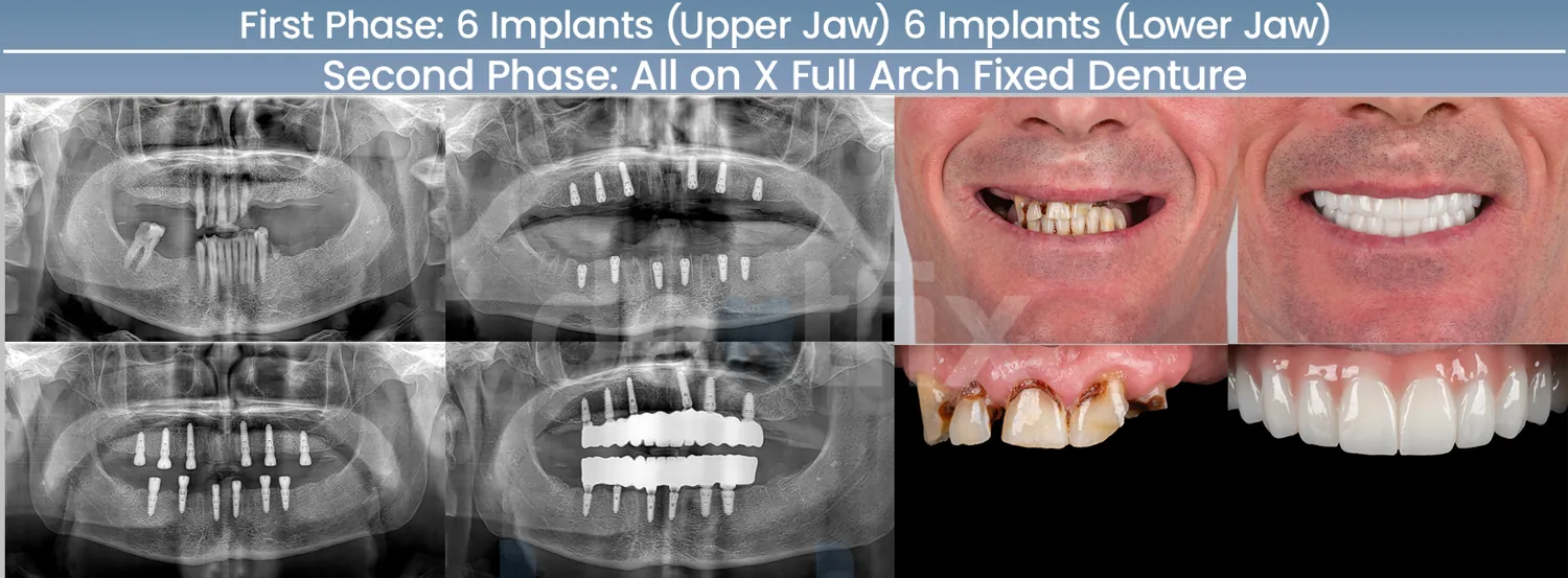 All-on-4 / All-on-6 full-mouth implant before and after — X-ray and smile, Dentfix Istanbul