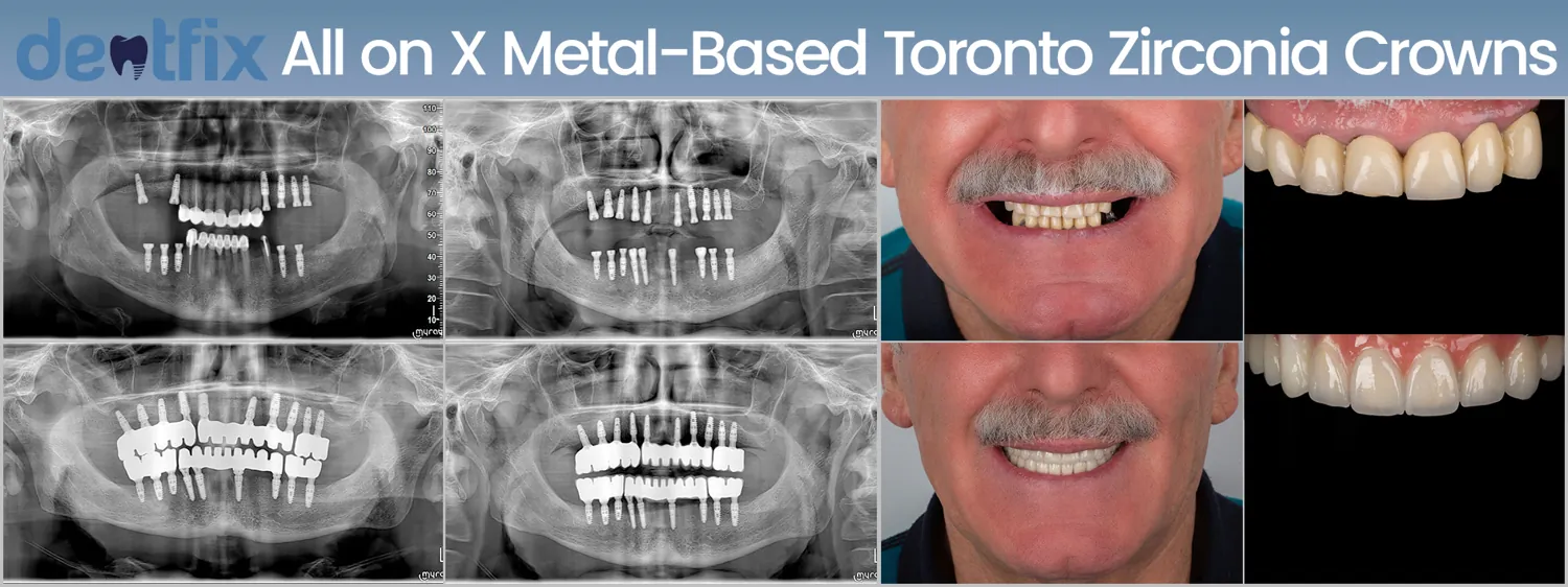 All-on-4 / All-on-6 full-mouth implant before and after — X-ray and smile, Dentfix Istanbul