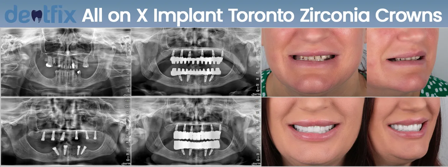All-on-4 / All-on-6 full-mouth implant before and after — X-ray and smile, Dentfix Istanbul