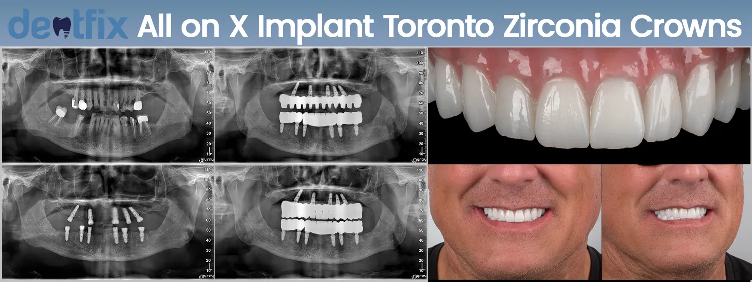 All-on-4 / All-on-6 full-mouth implant before and after — X-ray and smile, Dentfix Istanbul