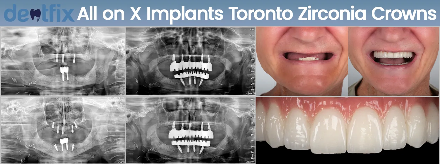Full-arch rehabilitation on zygomatic implants — Dentfix Istanbul