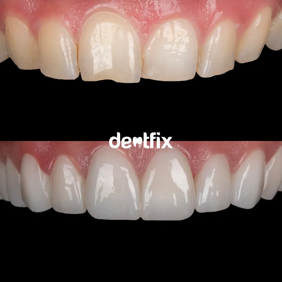 Before and after veneers result at Dentfix Istanbul