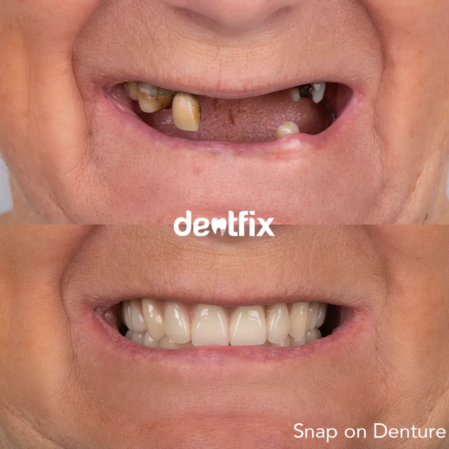 Before and after — veneers, crowns & Hollywood Smile at Dentfix Istanbul