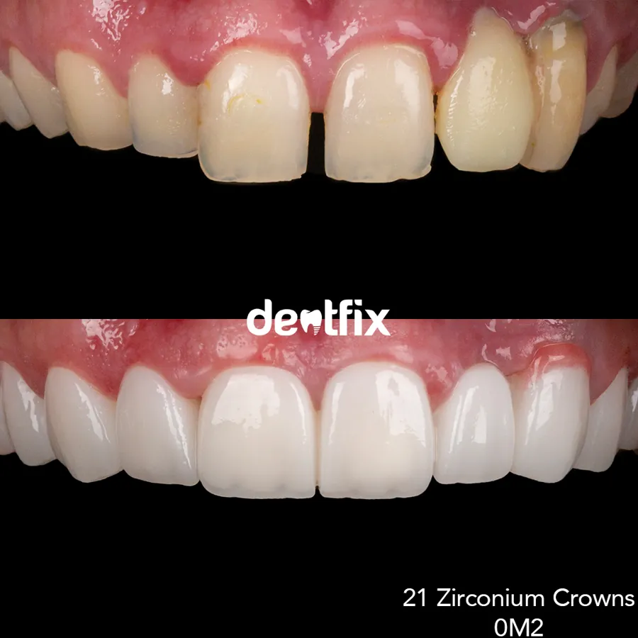 Before and after — veneers, crowns & Hollywood Smile at Dentfix Istanbul