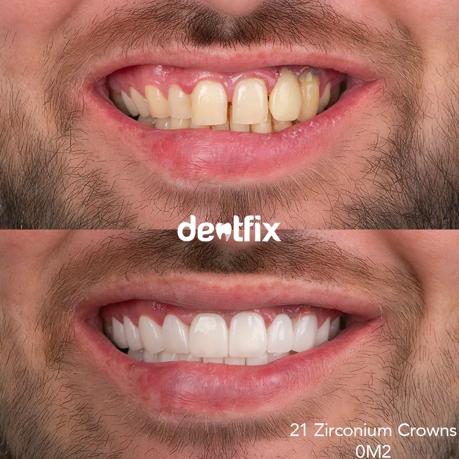 Before and after — veneers, crowns & Hollywood Smile at Dentfix Istanbul