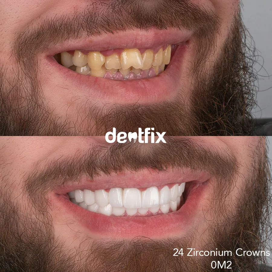 Before and after — veneers, crowns & Hollywood Smile at Dentfix Istanbul