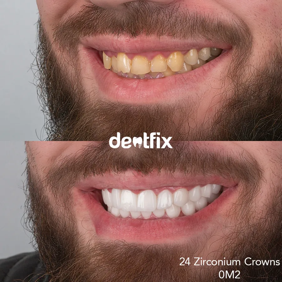 Before and after zirconium crowns result at Dentfix Istanbul