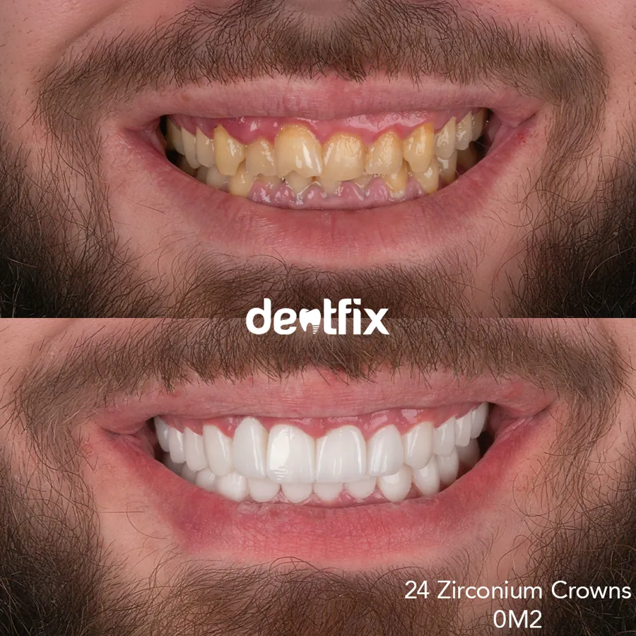 Before and after — veneers, crowns & Hollywood Smile at Dentfix Istanbul