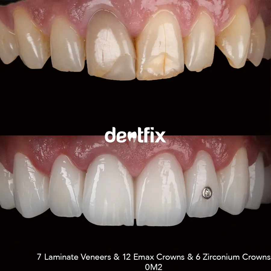 Before and after — veneers, crowns & Hollywood Smile at Dentfix Istanbul