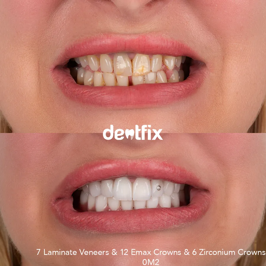 Before and after — veneers, crowns & Hollywood Smile at Dentfix Istanbul