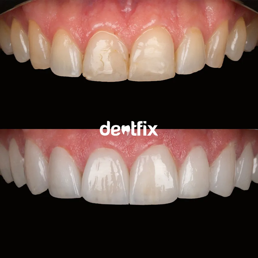 Before and after — veneers, crowns & Hollywood Smile at Dentfix Istanbul