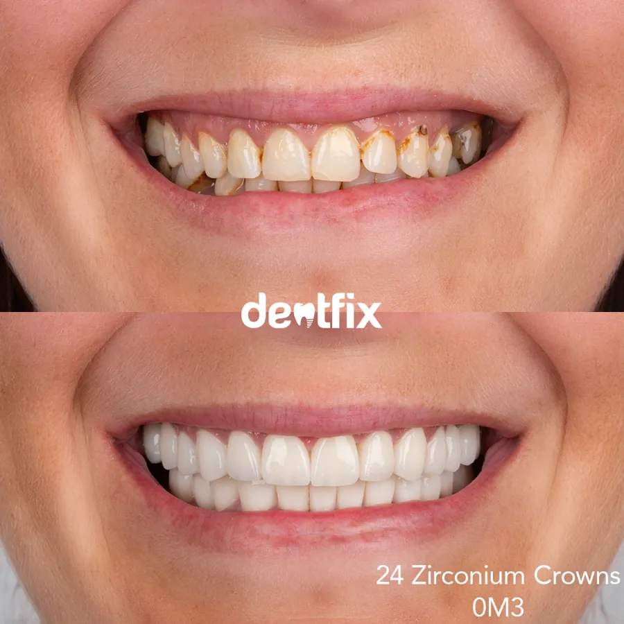 Hollywood Smile before and after at Dentfix Istanbul