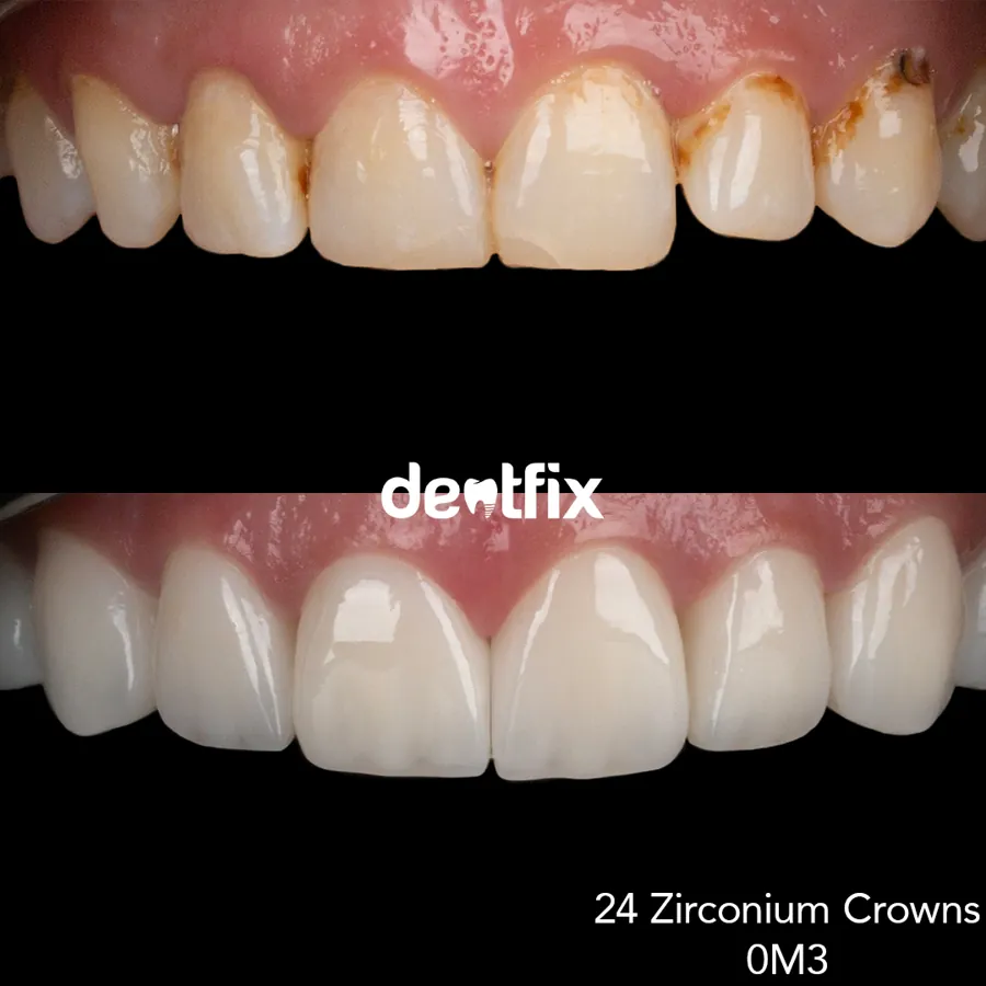 Before and after — veneers, crowns & Hollywood Smile at Dentfix Istanbul