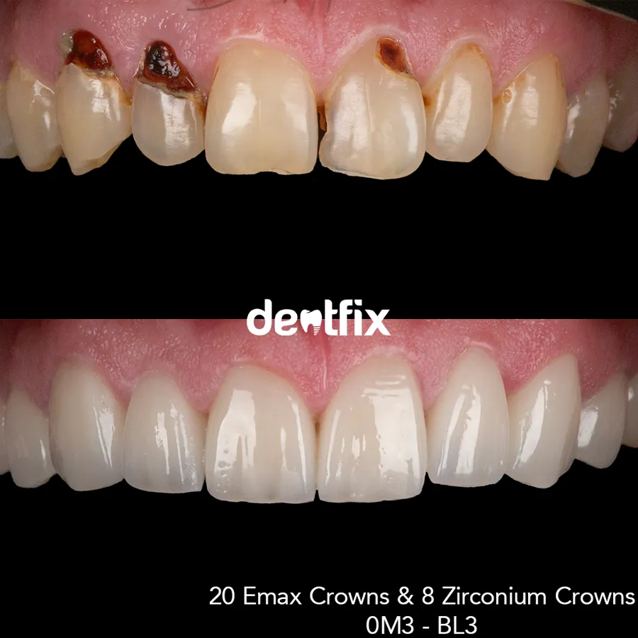 Before and after — veneers, crowns & Hollywood Smile at Dentfix Istanbul