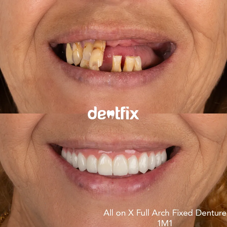 Before and after — veneers, crowns & Hollywood Smile at Dentfix Istanbul