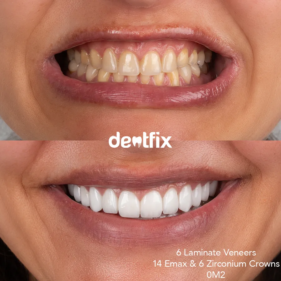 Smile makeover before and after at Dentfix Istanbul