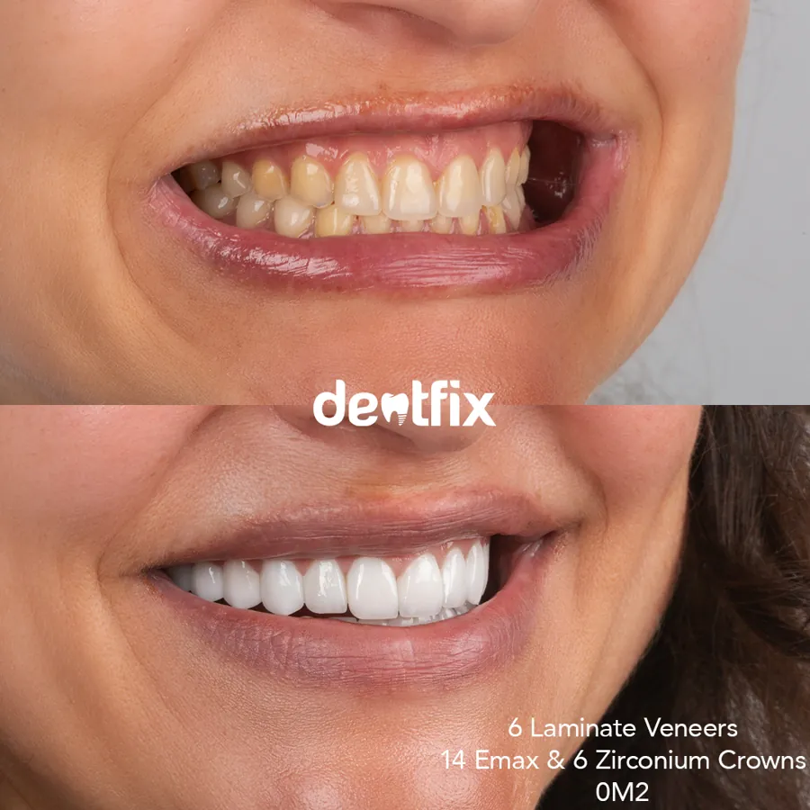 Before and after — veneers, crowns & Hollywood Smile at Dentfix Istanbul