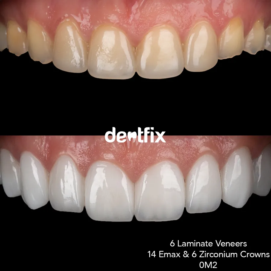 Before and after — veneers, crowns & Hollywood Smile at Dentfix Istanbul
