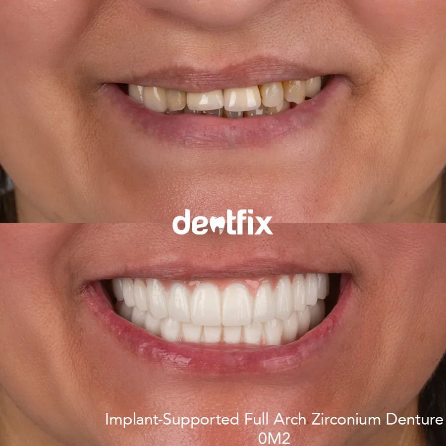 Before and after — veneers, crowns & Hollywood Smile at Dentfix Istanbul