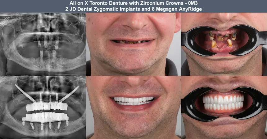 Zygomatic implant case — before and after panoramic X-ray and smile: 2 JD Dental zygomatic + 8 Megagen implants · fixed full-arch zirconia bridge